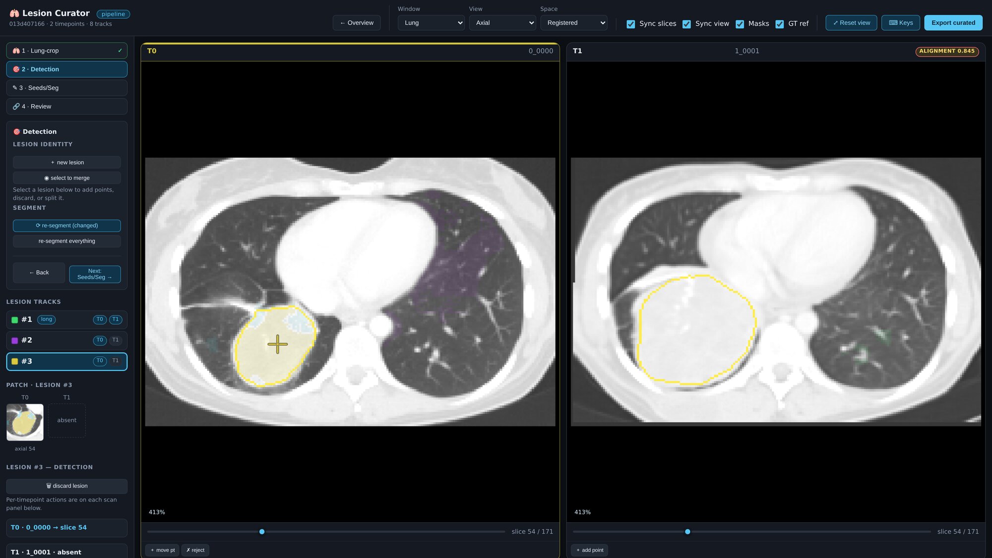 Lesion Curator 的界面。左边的侧栏列出四个阶段和各个 lesion track。中间是同一个患者两次检查的轴位胸部 CT 切片，并排摆放。第一次检查上，检测到的病灶填上了 mask；第二次检查上，一个黄色的参考轮廓标出了一个没有检测到的病灶。